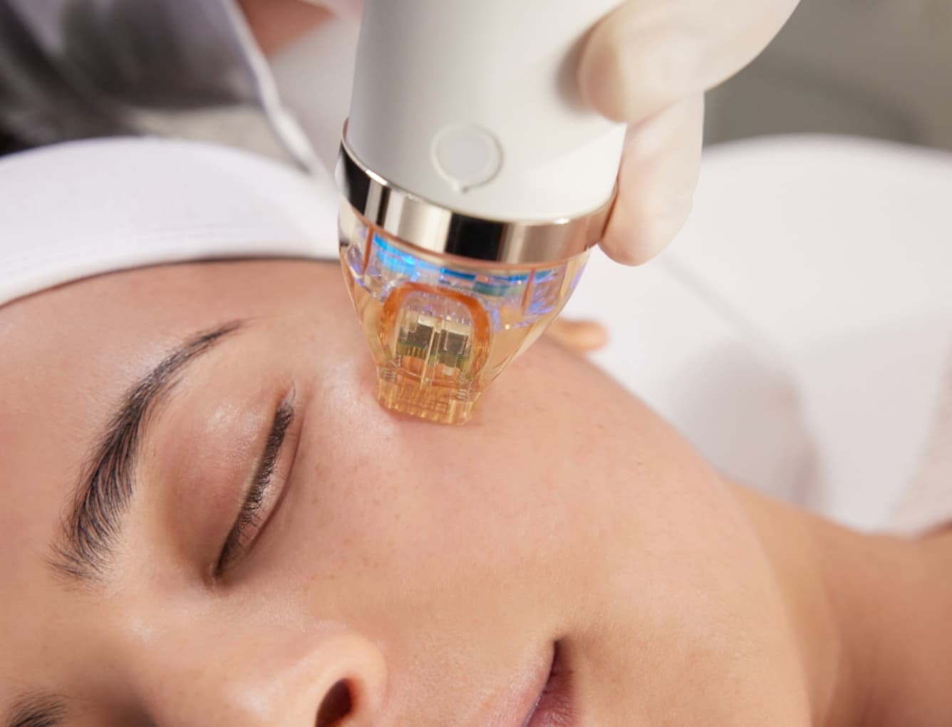 RF Microneedling Skin Tightening